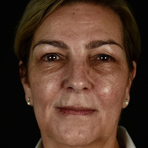 Before BBL treatment, addressing redness and broken blood vessels.