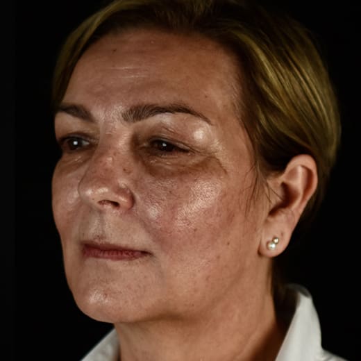 Before BBL treatment, addressing redness and broken blood vessels.