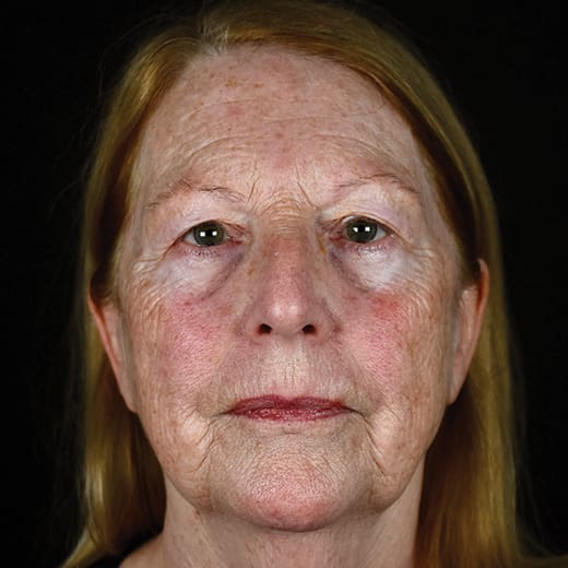 Before BBL treatment, addressing rough skin and enlarged pores.