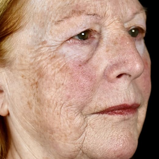 Before BBL treatment, addressing rough skin and enlarged pores.