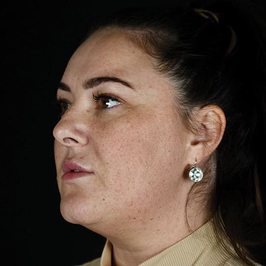 Before BBL treatment, addressing sun damage, freckles, and lower cheek wrinkles.