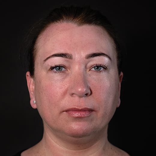 Before cheek filler and wrinkle-relaxing injections, addressing sagging cheeks and frown lines.