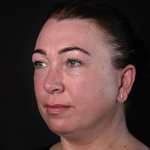 Before cheek filler and wrinkle-relaxing injections, addressing sagging cheeks and frown lines.