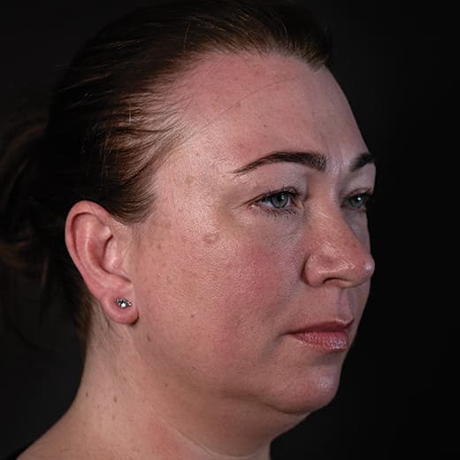 Before cheek filler and wrinkle-relaxing injections, addressing sagging cheeks and frown lines.