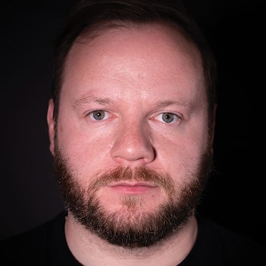 Before cheek and tear trough filler, addressing signs of tiredness around the male eyes