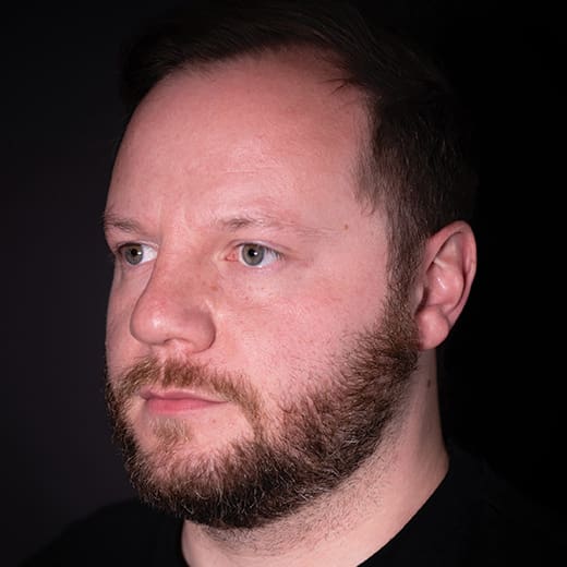 Before cheek and tear trough filler, addressing signs of tiredness around the male eyes