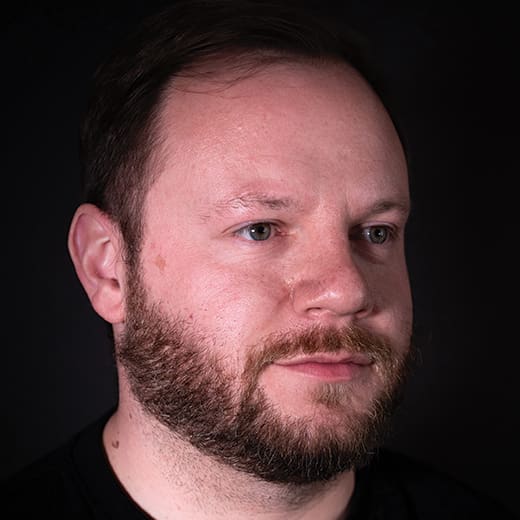 Before cheek and tear trough filler, addressing signs of tiredness around the male eyes