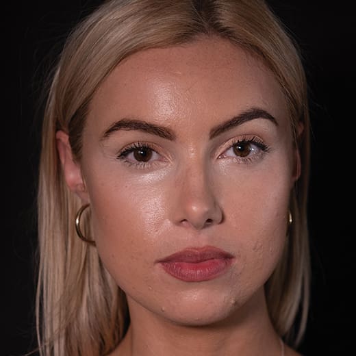 Before chin and jaw filler with chin augmentation, addressing a deficient jawline.