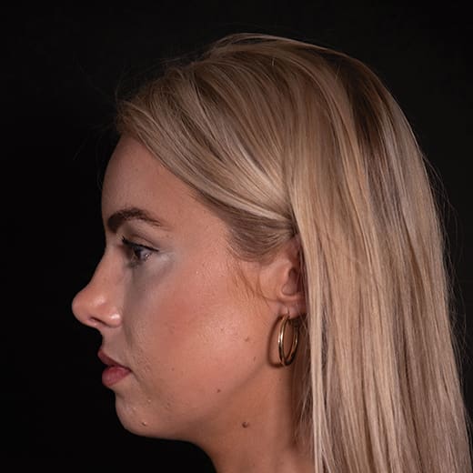 Before chin and jaw filler with chin augmentation, addressing a deficient jawline.