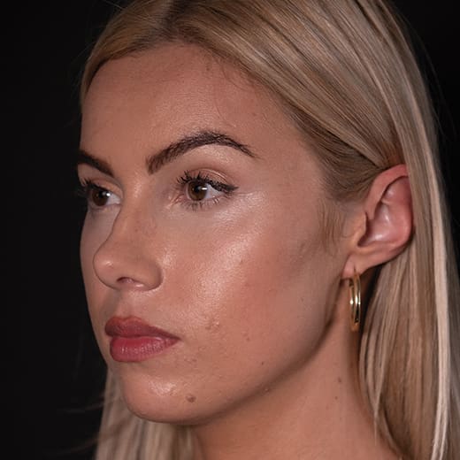 Before chin and jaw filler with chin augmentation, addressing a deficient jawline.