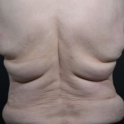Before CoolSculpting, addressing back fat and bra fat