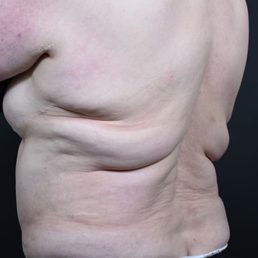 Before CoolSculpting, addressing back fat and bra fat