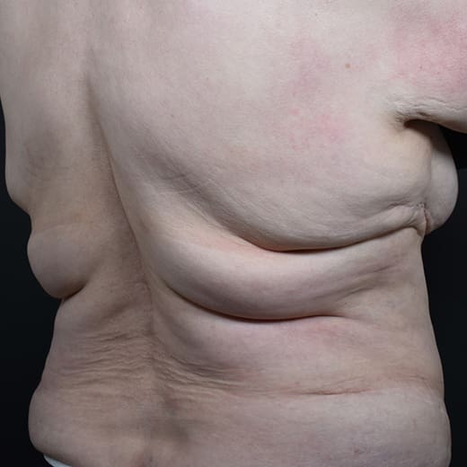 Before CoolSculpting, addressing back fat and bra fat