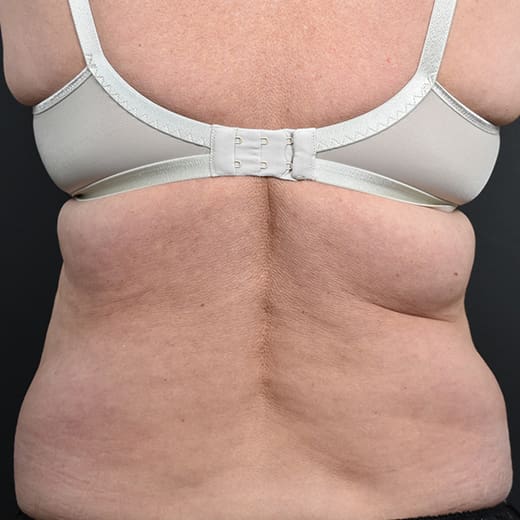 Before CoolSculpting, addressing back fat and bra fat.