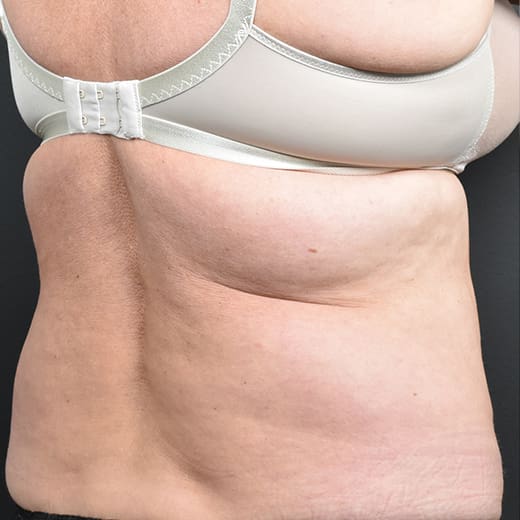 Before CoolSculpting, addressing back fat and bra fat.