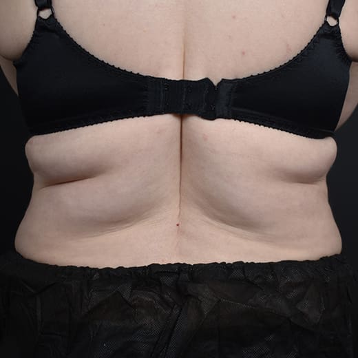 Before CoolSculpting, addressing back fat and bra fat.