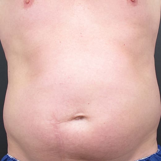 Before CoolSculpting, addressing male belly fat (dad bod).