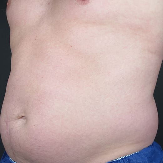 Before CoolSculpting, addressing male belly fat (dad bod).