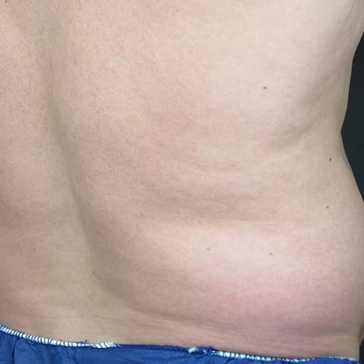 Before CoolSculpting, addressing male belly fat (dad bod).