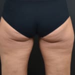Before treatment, addressing inner & outter thighs and bum.