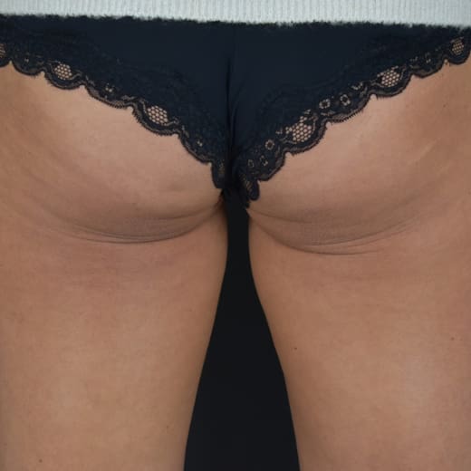 Before CoolSculpting, addressing inner thighs and bum.