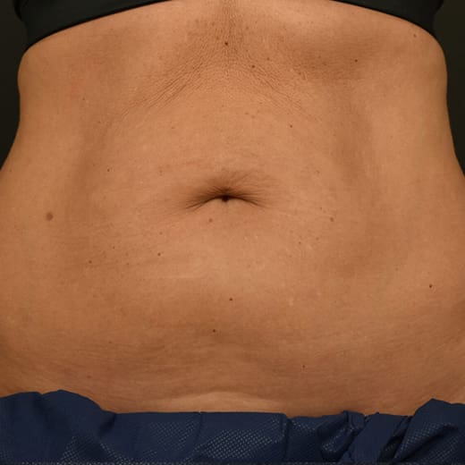 Before CoolSculpting, addressing mummy tummy and belly fat.