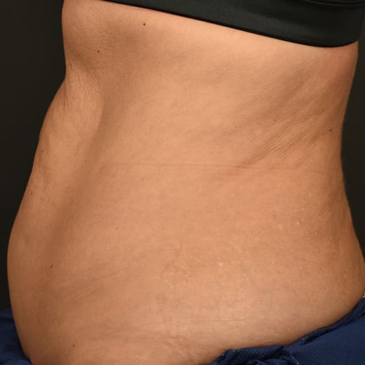 Before CoolSculpting, addressing mummy tummy and belly fat.