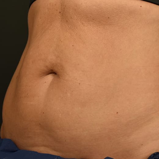 Before CoolSculpting, addressing mummy tummy and belly fat.