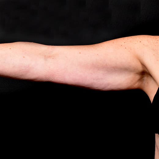 Before CoolSculpting, addressing sagging arms (bingo wings).