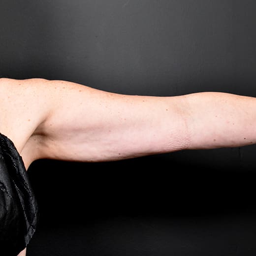 Before CoolSculpting, addressing sagging arms (bingo wings).