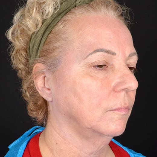 Before deep plane face and neck lift with jowl lift, addressing jowls, sagging neck, and sagging jawline