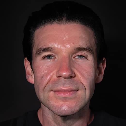 Before dermal fillers, addressing sagging cheeks and jawline in the male face