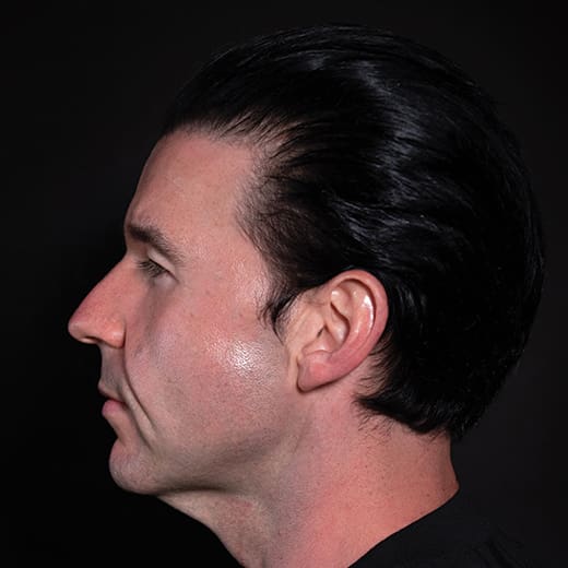Before dermal fillers, addressing sagging cheeks and jawline in the male face