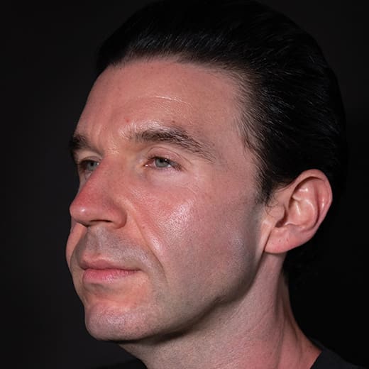 Before dermal fillers, addressing sagging cheeks and jawline in the male face