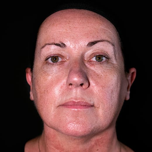 Before dermal fillers, addressing sagging cheeks.