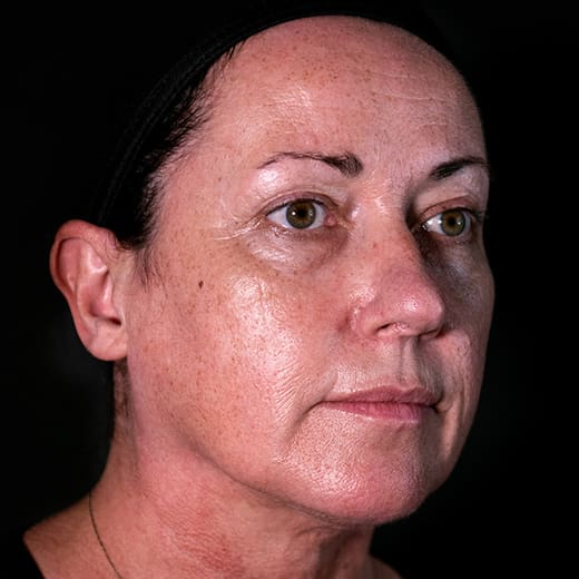 Before dermal fillers, addressing sagging cheeks.