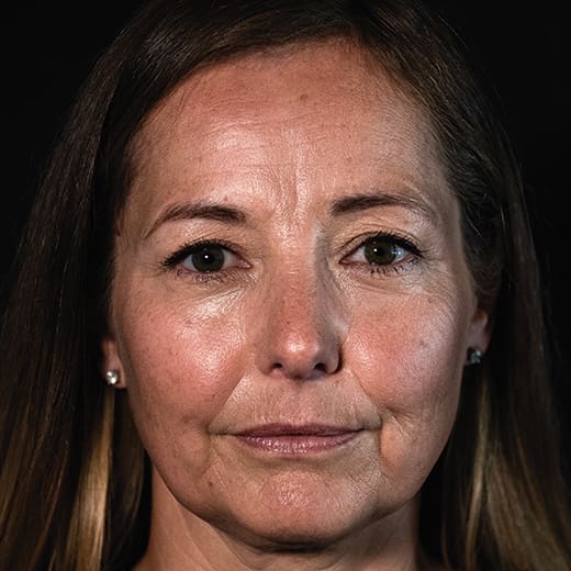 Before facial fillers including lip augmentation, addressing lip lines, marionette lines, thin lips, reduced lip volume, and lipstick/smokers' lines.