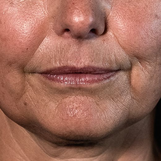 Before facial fillers including lip augmentation, addressing lip lines, marionette lines, thin lips, reduced lip volume, and lipstick/smokers' lines.