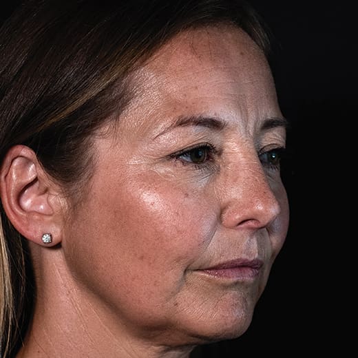 Before facial fillers including lip augmentation, addressing lip lines, marionette lines, thin lips, reduced lip volume, and lipstick/smokers' lines.