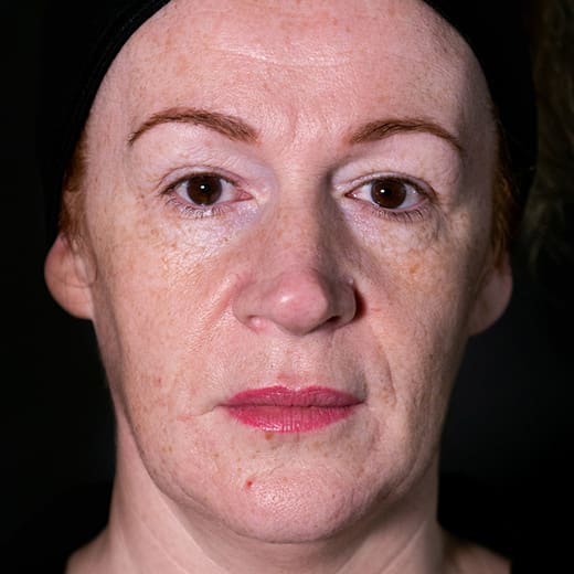 ChatGPT said: Before fillers, addressing nose-to-mouth lines (laughter lines)