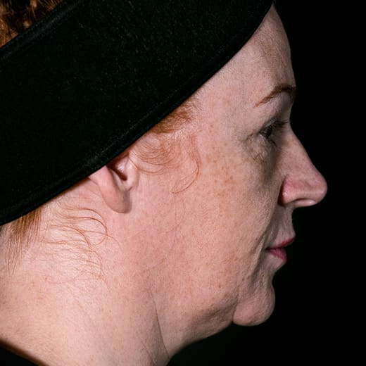 ChatGPT said: Before fillers, addressing nose-to-mouth lines (laughter lines)