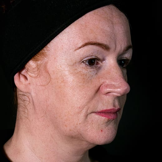 ChatGPT said: Before fillers, addressing nose-to-mouth lines (laughter lines)