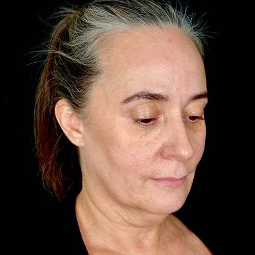 Before full facelift with deep plane face and neck lift and jowl lift, addressing sagging neck, sagging jawline, and sagging jowls
