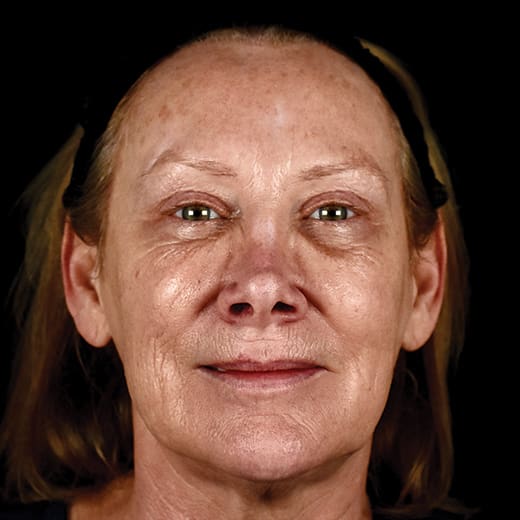 Before full laser resurfacing, addressing lipstick lines and smokers' lines.