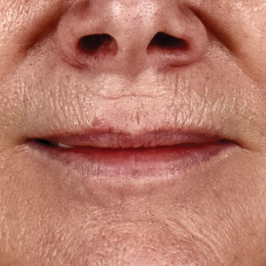 Before full laser resurfacing, addressing lipstick lines and smokers' lines