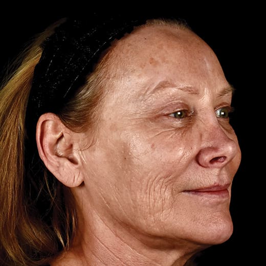 Before full laser resurfacing, addressing lipstick lines and smokers' lines.