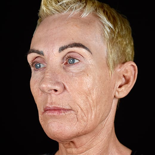 Before full laser resurfacing, addressing scars and scarring