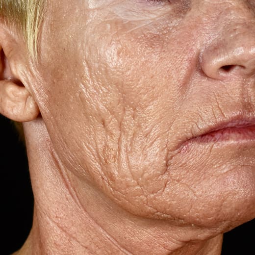 Before full laser resurfacing, addressing scars and scarring