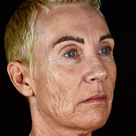 Before full laser resurfacing, addressing scars and scarring