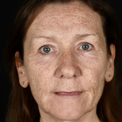 Before full laser skin resurfacing, addressing fine lines and wrinkles in the lower cheek.